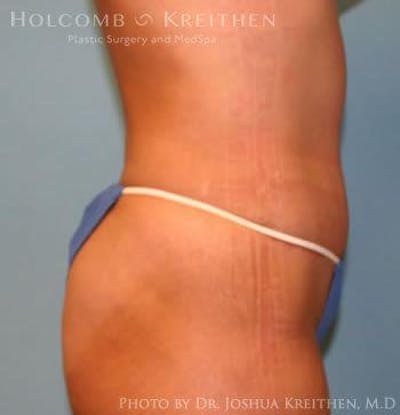 Tummy Tuck Before & After Gallery - Patient 6236445 - Image 4