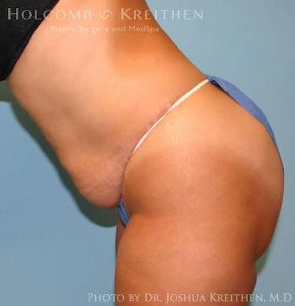 Tummy Tuck Before & After Gallery - Patient 6236445 - Image 5