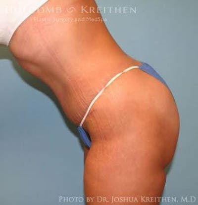Tummy Tuck Before & After Gallery - Patient 6236445 - Image 6