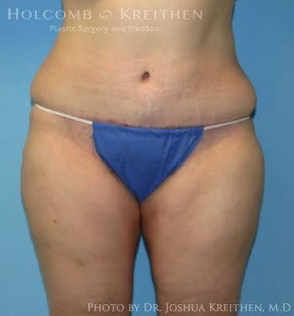 Tummy Tuck Before & After Gallery - Patient 6236446 - Image 2