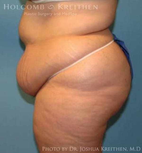 Tummy Tuck Before & After Gallery - Patient 6236446 - Image 3