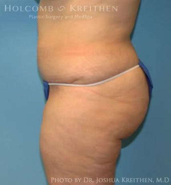 Tummy Tuck Before & After Gallery - Patient 6236446 - Image 4