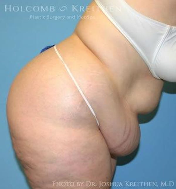 Tummy Tuck Before & After Gallery - Patient 6236446 - Image 5