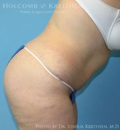 Tummy Tuck Before & After Gallery - Patient 6236446 - Image 6