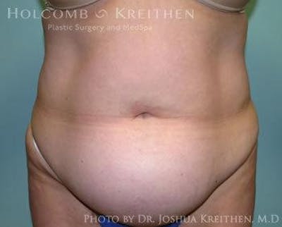 Tummy Tuck Before & After Gallery - Patient 6236447 - Image 1
