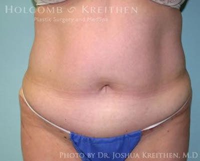 Tummy Tuck Before & After Gallery - Patient 6236447 - Image 2