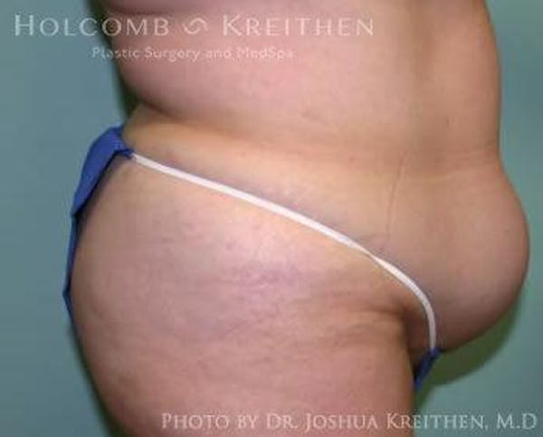 Tummy Tuck Before & After Gallery - Patient 6236447 - Image 3