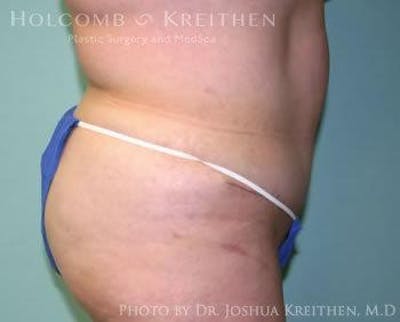 Tummy Tuck Before & After Gallery - Patient 6236447 - Image 4