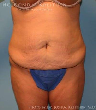 Tummy Tuck Before & After Gallery - Patient 6236453 - Image 1