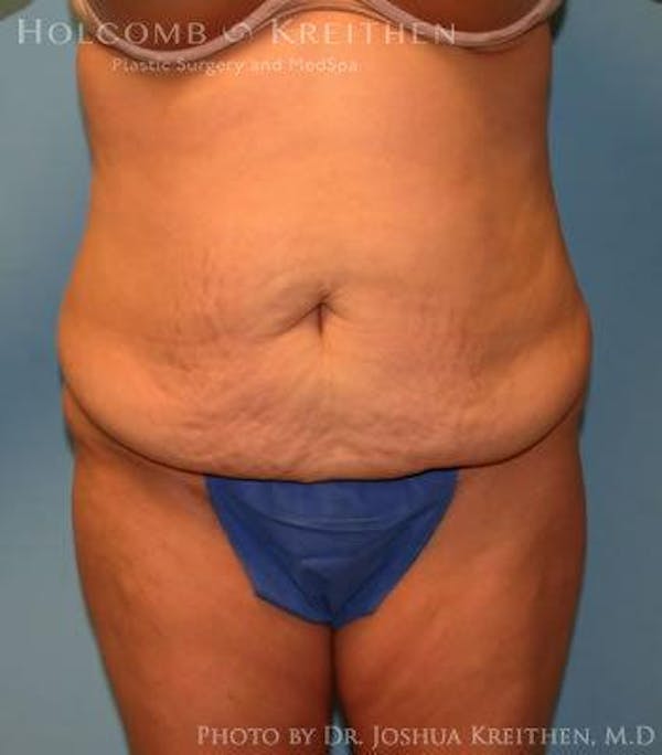 Tummy Tuck Before & After Gallery - Patient 6236453 - Image 1