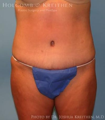 Tummy Tuck Gallery - Patient 6236453 - Image 2