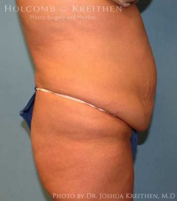 Tummy Tuck Before & After Gallery - Patient 6236453 - Image 3