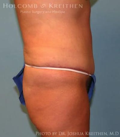 Tummy Tuck Before & After Gallery - Patient 6236453 - Image 4