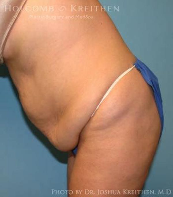 Tummy Tuck Before & After Gallery - Patient 6236453 - Image 5