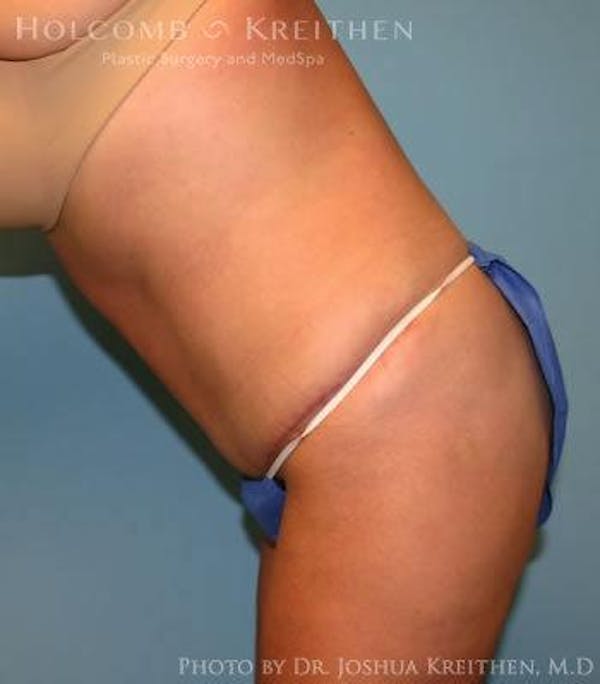 Tummy Tuck Before & After Gallery - Patient 6236453 - Image 6