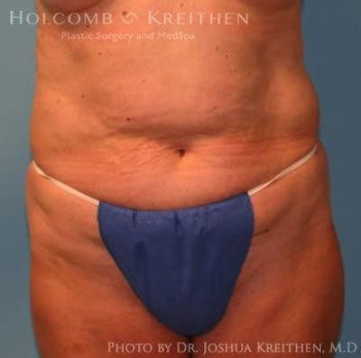 Tummy Tuck Before & After Gallery - Patient 6236458 - Image 1