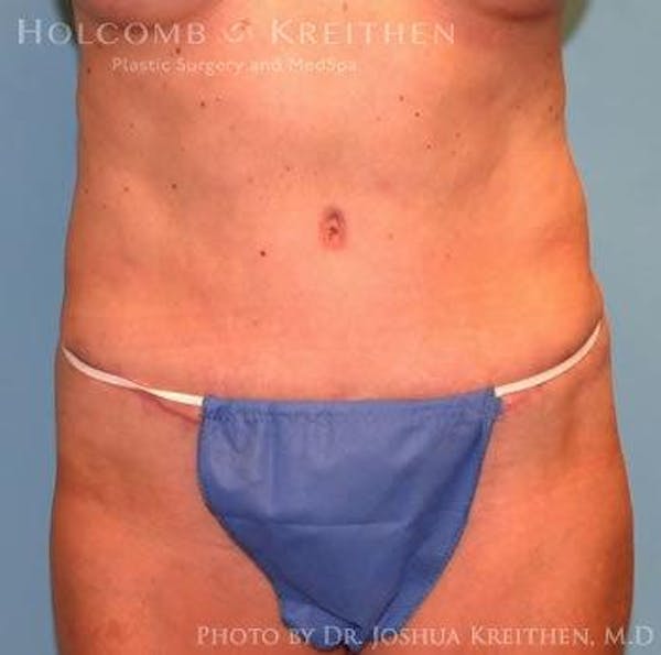Tummy Tuck Gallery - Patient 6236458 - Image 2