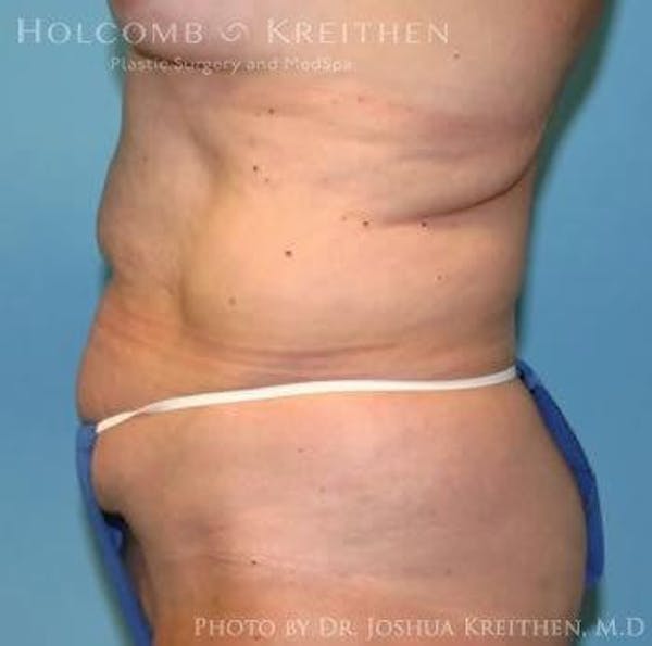 Tummy Tuck Before & After Gallery - Patient 6236458 - Image 3