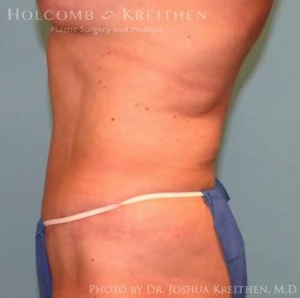 Tummy Tuck Before & After Gallery - Patient 6236458 - Image 4