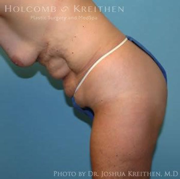Tummy Tuck Before & After Gallery - Patient 6236458 - Image 5