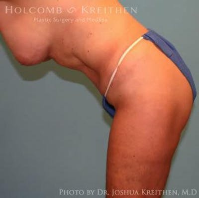 Tummy Tuck Gallery - Patient 6236458 - Image 6