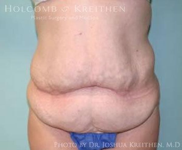 Tummy Tuck Before & After Gallery - Patient 6236460 - Image 1