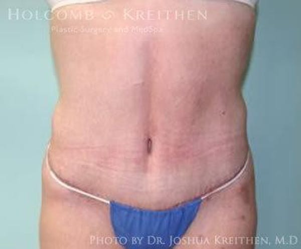Tummy Tuck Before & After Gallery - Patient 6236460 - Image 2