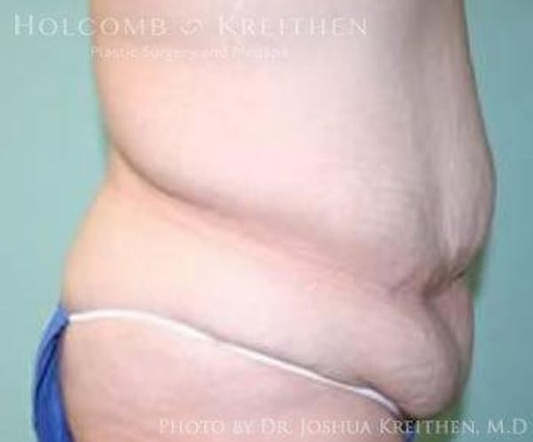 Tummy Tuck Before & After Gallery - Patient 6236460 - Image 3
