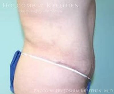Tummy Tuck Gallery - Patient 6236460 - Image 4