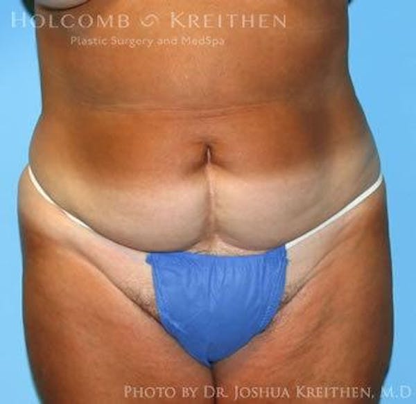 Tummy Tuck Before & After Gallery - Patient 6236463 - Image 1