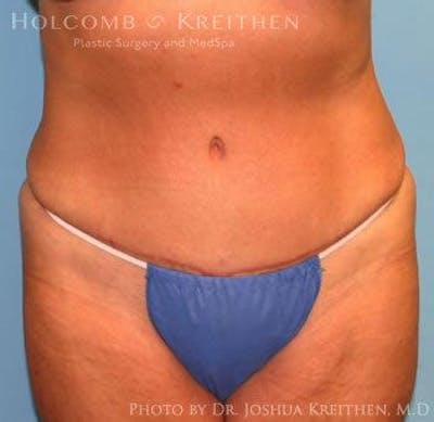 Tummy Tuck Before & After Gallery - Patient 6236463 - Image 2