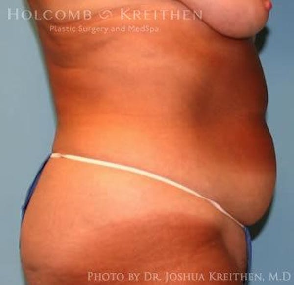 Tummy Tuck Before & After Gallery - Patient 6236463 - Image 3