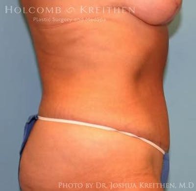 Tummy Tuck Before & After Gallery - Patient 6236463 - Image 4