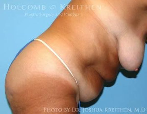 Tummy Tuck Before & After Gallery - Patient 6236463 - Image 5