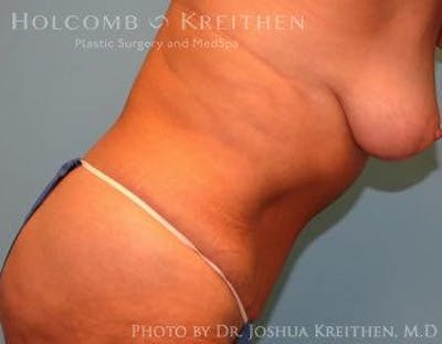 Tummy Tuck Before & After Gallery - Patient 6236463 - Image 6