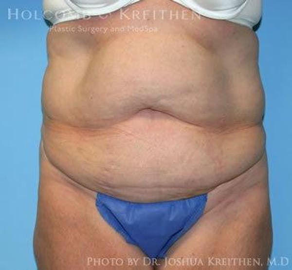 Tummy Tuck Before & After Gallery - Patient 6236468 - Image 1