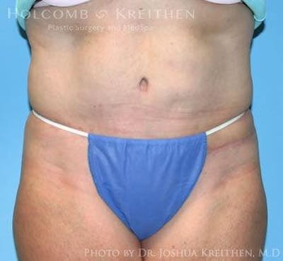 Tummy Tuck Before & After Gallery - Patient 6236468 - Image 2
