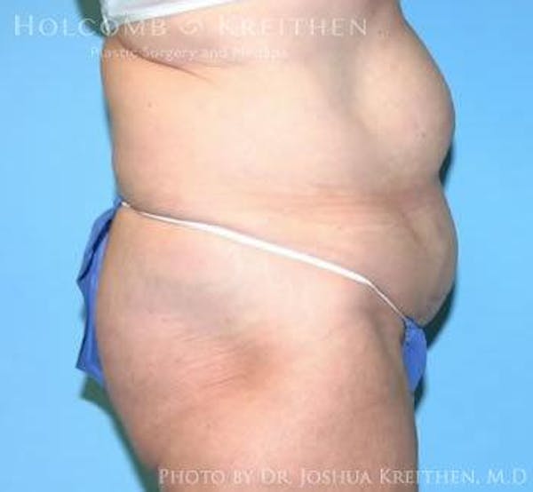 Tummy Tuck Before & After Gallery - Patient 6236468 - Image 3