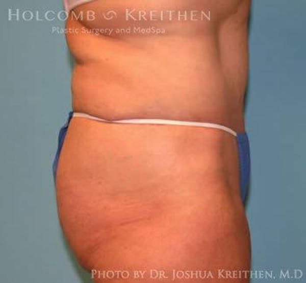 Tummy Tuck Gallery - Patient 6236468 - Image 4