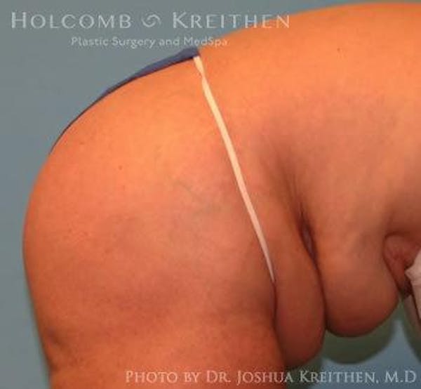 Tummy Tuck Before & After Gallery - Patient 6236468 - Image 5