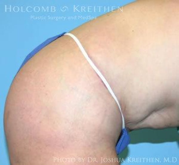 Tummy Tuck Gallery - Patient 6236468 - Image 6