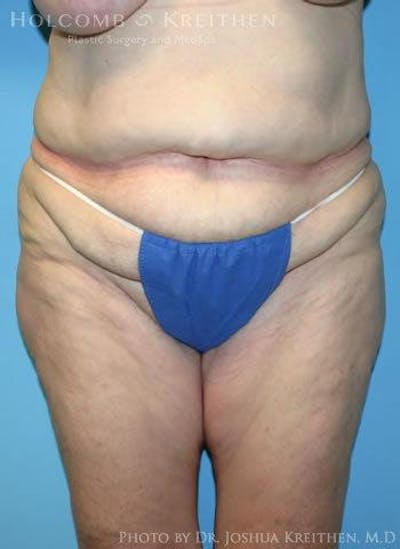 Tummy Tuck Before & After Gallery - Patient 6236473 - Image 1