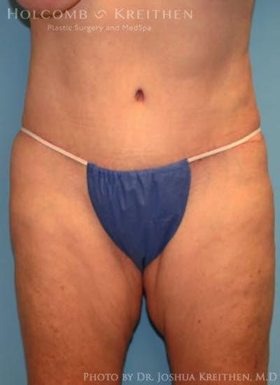 Tummy Tuck Before & After Gallery - Patient 6236473 - Image 2