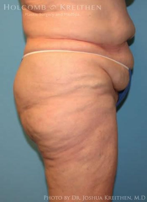 Tummy Tuck Before & After Gallery - Patient 6236473 - Image 3
