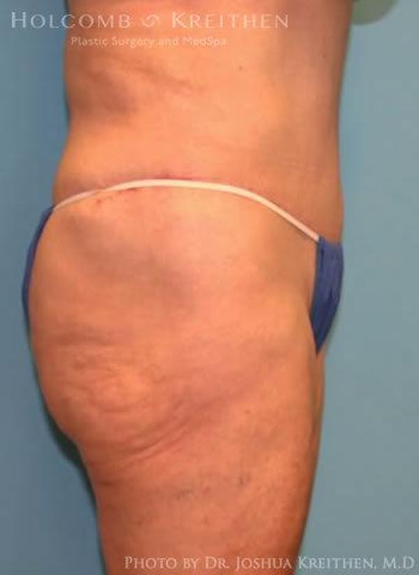 Tummy Tuck Before & After Gallery - Patient 6236473 - Image 4