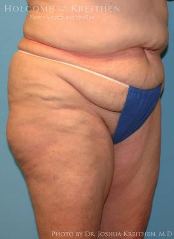 Tummy Tuck Before & After Gallery - Patient 6236473 - Image 5