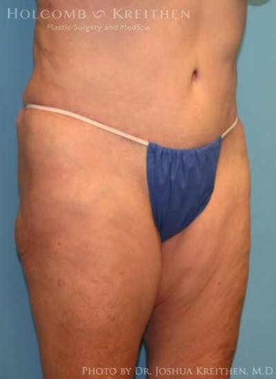 Tummy Tuck Before & After Gallery - Patient 6236473 - Image 6