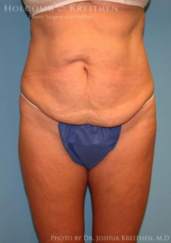 Tummy Tuck Before & After Gallery - Patient 6236476 - Image 1