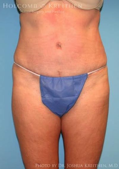 Tummy Tuck Before & After Gallery - Patient 6236476 - Image 2
