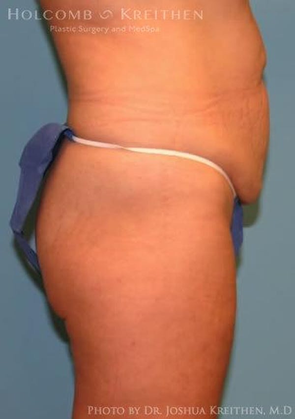 Tummy Tuck Before & After Gallery - Patient 6236476 - Image 3